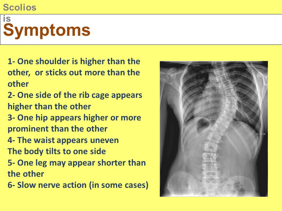 Types of Spine Curvature Disorders